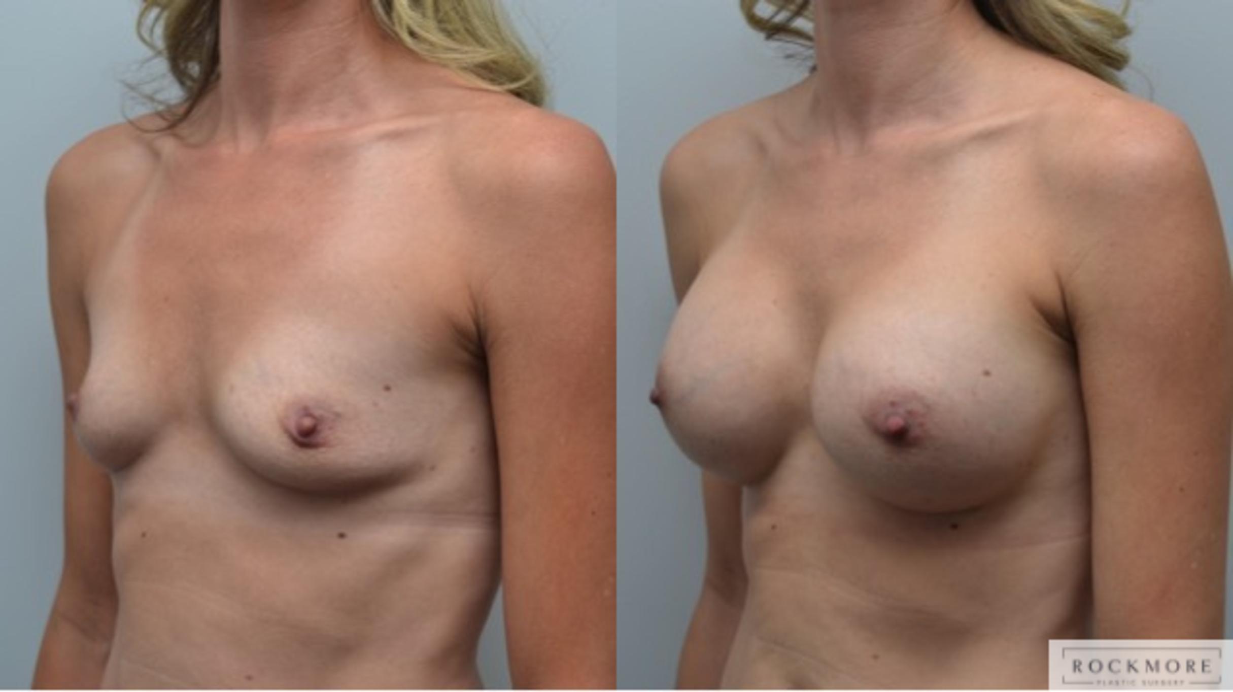 Before & After Breast Augmentation Case 284 View #3 View in Albany & Latham, New York