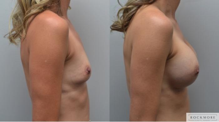 Before & After Breast Augmentation Case 284 View #4 View in Albany & Latham, New York