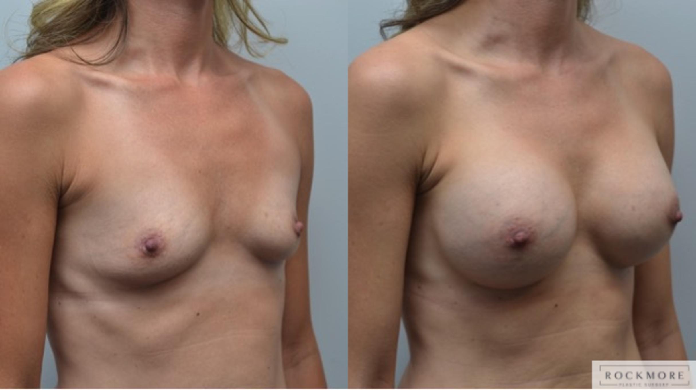 Before & After Breast Augmentation Case 284 View #5 View in Albany & Latham, New York
