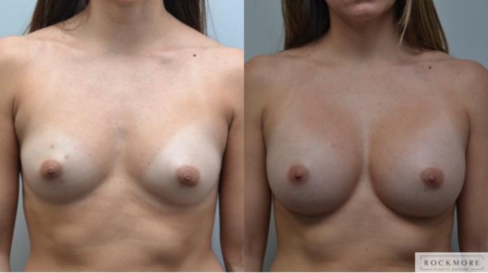 Before & After Breast Augmentation Case 285 View #1 View in Albany & Latham, New York