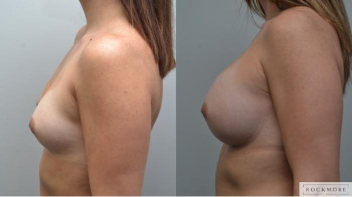 Before & After Breast Augmentation Case 285 View #2 View in Albany & Latham, New York