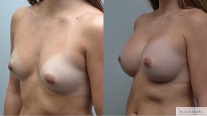 Before & After Breast Augmentation Case 285 View #3 View in Albany & Latham, New York