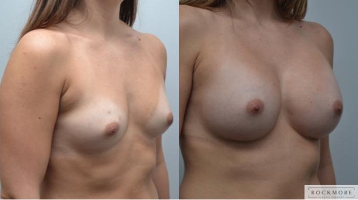 Before & After Breast Augmentation Case 285 View #4 View in Albany & Latham, New York