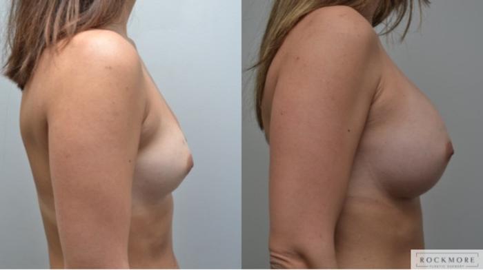 Before & After Breast Augmentation Case 285 View #5 View in Albany & Latham, New York