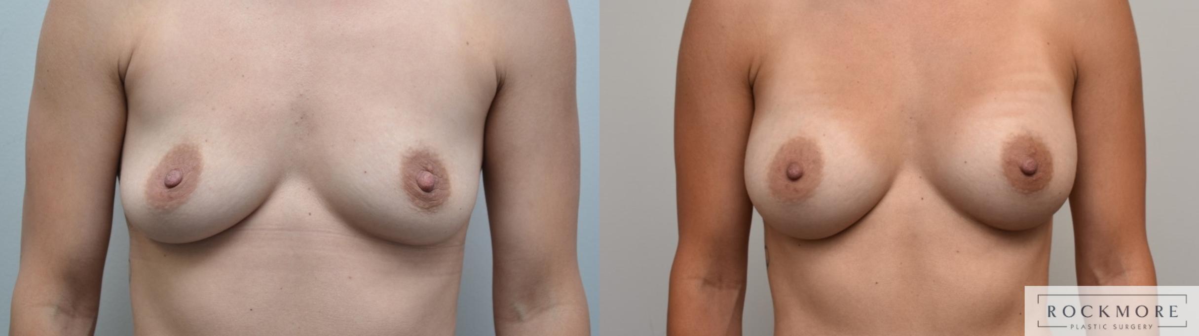 Before & After Breast Augmentation Case 307 View #1 View in Albany & Latham, New York