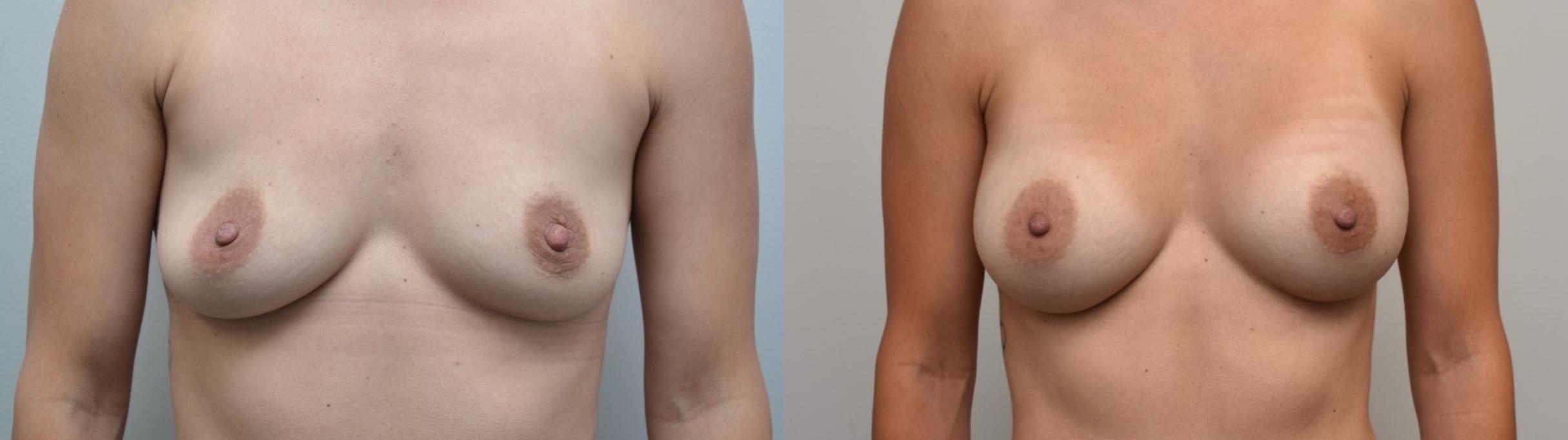 Before & After Breast Augmentation Case 307 View #1 View in Albany & Latham, New York