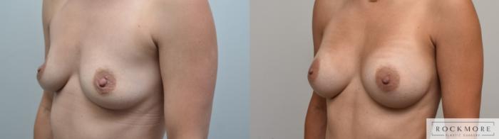 Before & After Breast Augmentation Case 307 View #3 View in Albany & Latham, New York