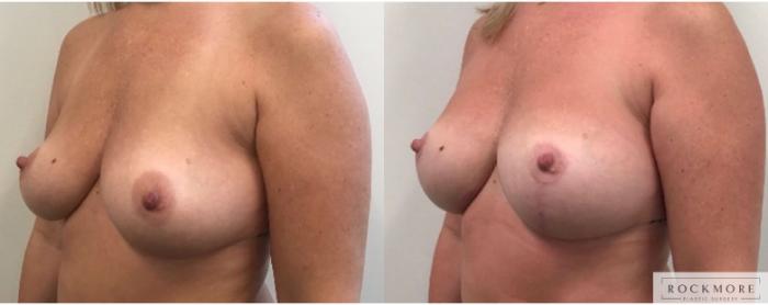 Breast Augmentation and lift