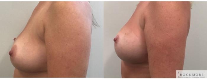 Before & After Breast Lift Case 319 Left Side View in Albany & Latham, New York