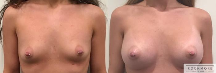 Before & After Breast Augmentation Case 320 Front View in Albany & Latham, New York