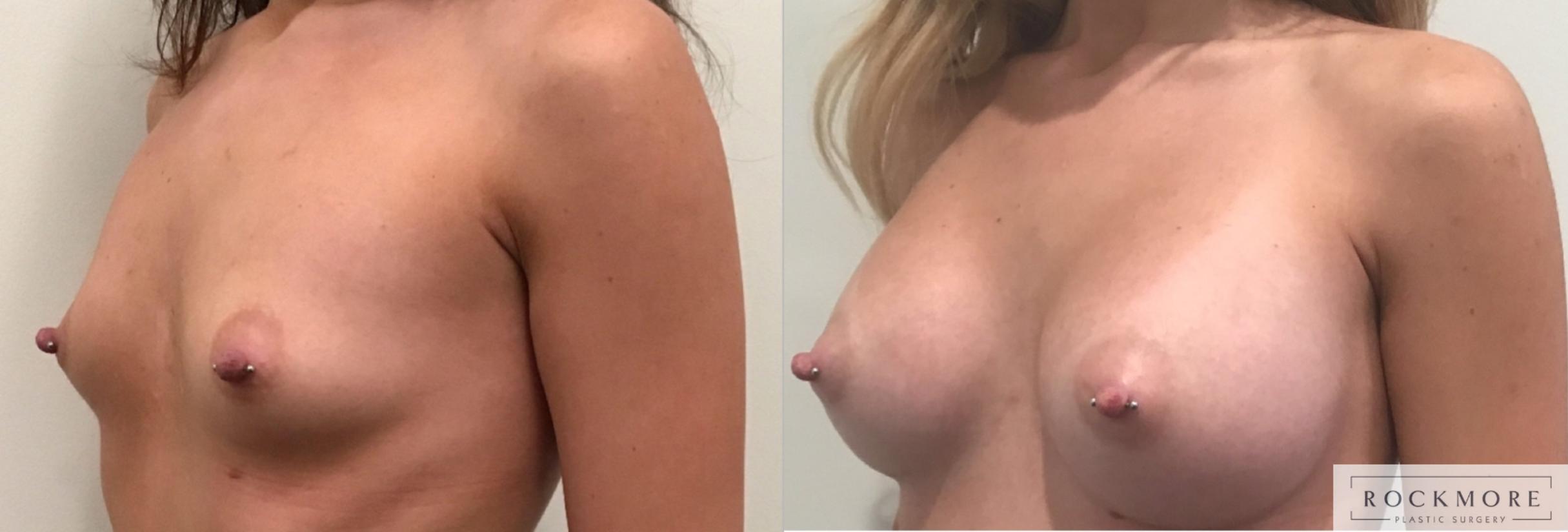 Before & After Breast Augmentation Case 320 Left Oblique View in Albany & Latham, New York