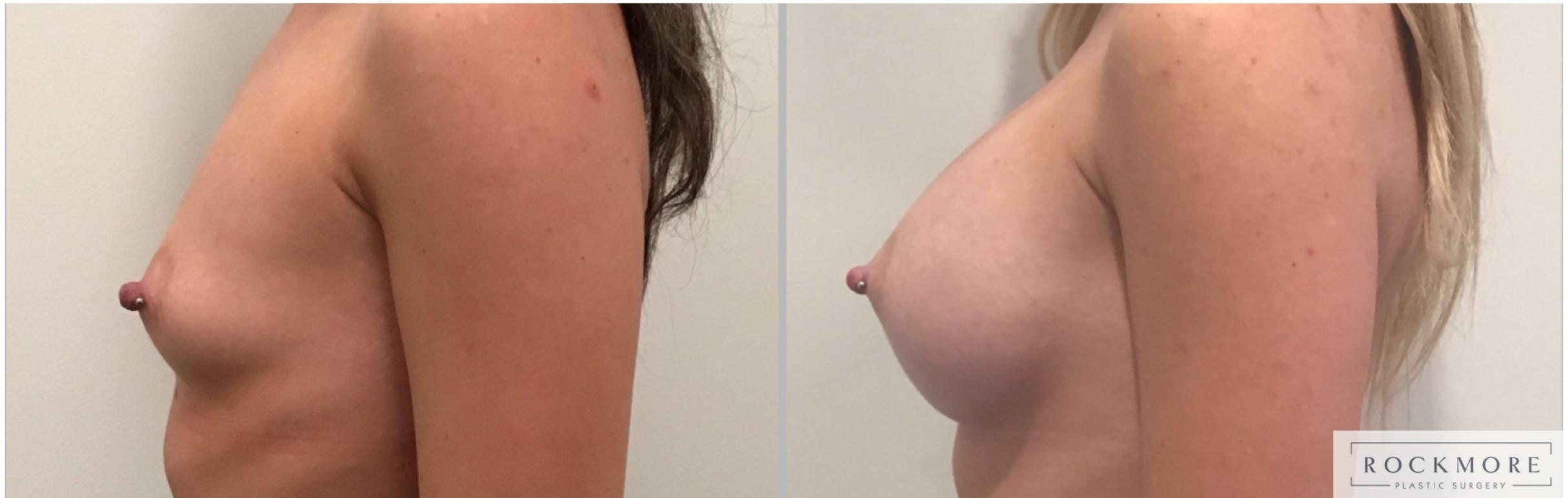 Before & After Breast Augmentation Case 320 Left Side View in Albany & Latham, New York