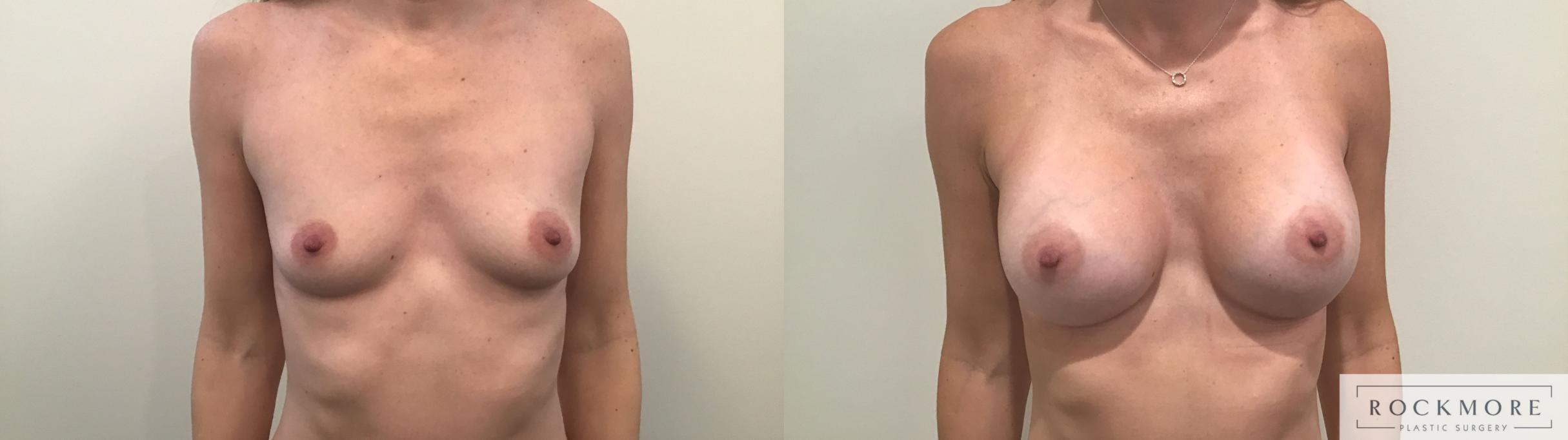 Before & After Breast Augmentation Case 324 Front View in Albany & Latham, New York