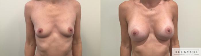 Before & After Breast Augmentation Case 324 Front View in Albany & Latham, New York