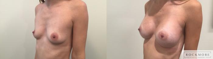 Before & After Breast Augmentation Case 324 Left Oblique View in Albany & Latham, New York