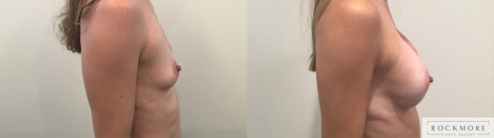 Before & After Breast Augmentation Case 324 Right Side View in Albany & Latham, New York