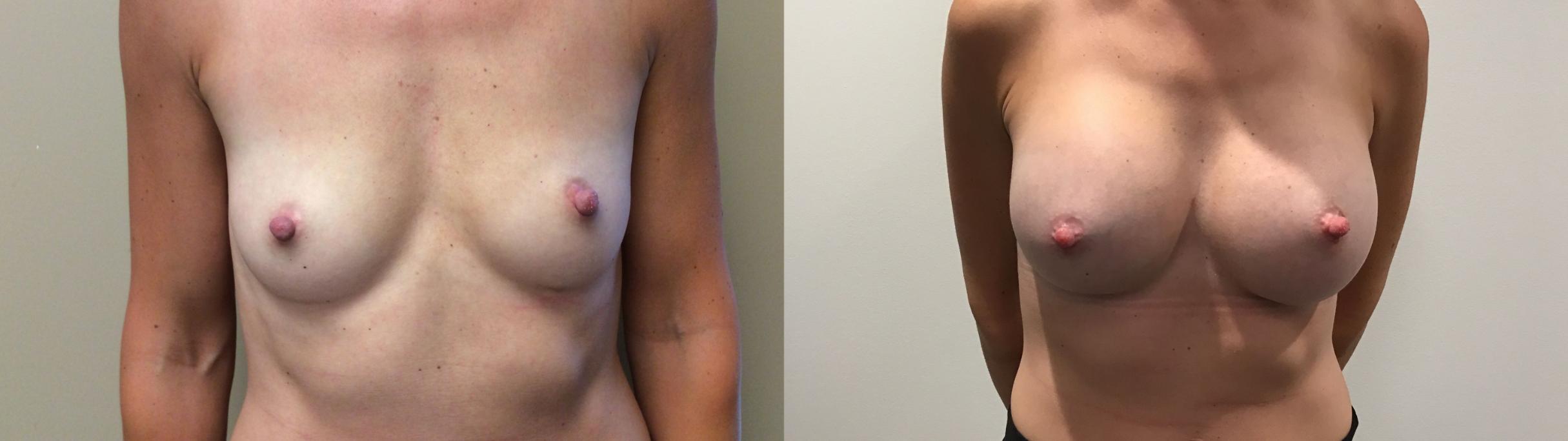 Before & After Breast Augmentation Case 344 Front View in Albany, Latham & Saratoga, New York