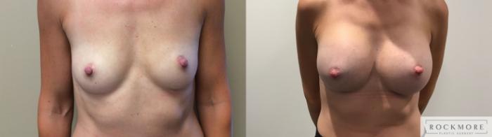 Before & After Breast Augmentation Case 344 Front View in Albany & Latham, New York
