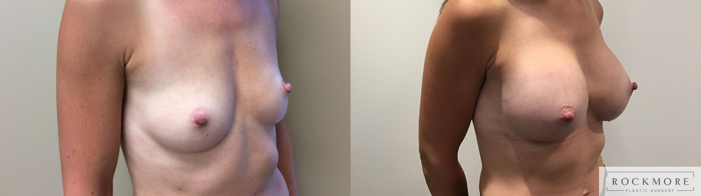 Before & After Breast Augmentation Case 344 Right Oblique View in Albany & Latham, New York