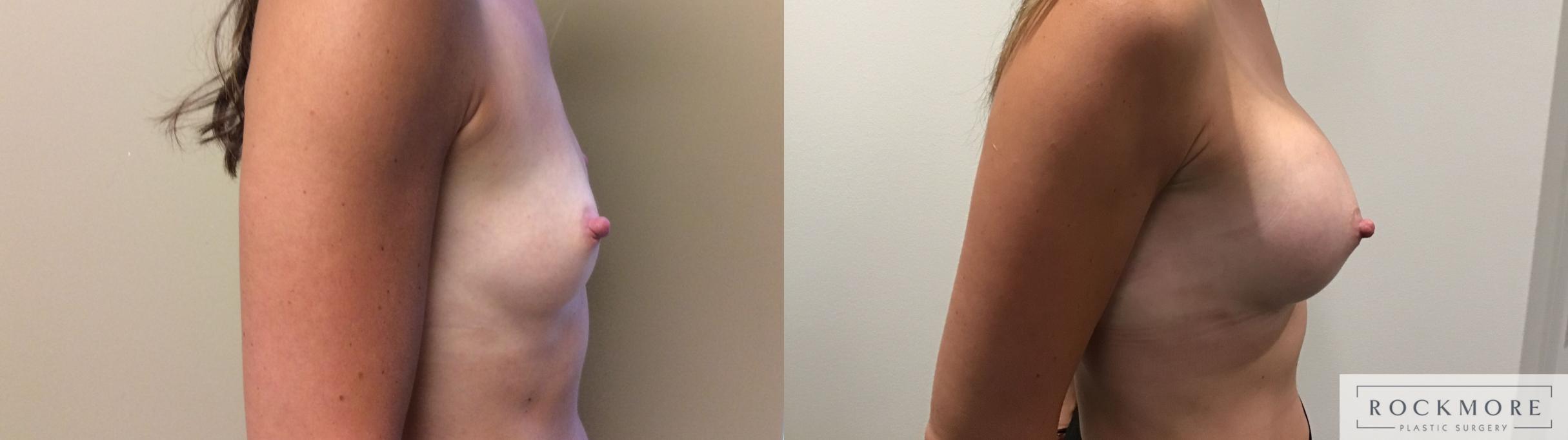 Before & After Breast Augmentation Case 344 Right Side View in Albany & Latham, New York