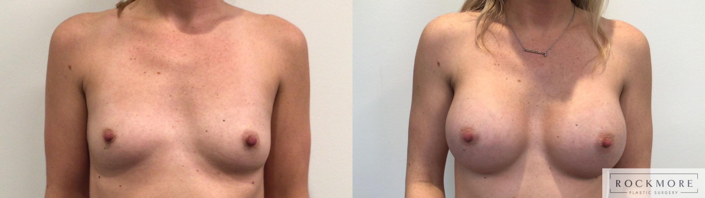 Before & After Breast Augmentation Case 445 Front View in Albany & Latham, New York