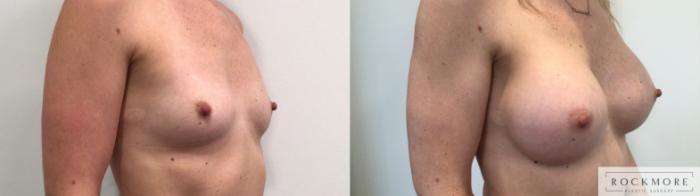 Before & After Breast Augmentation Case 445 Left Side View in Albany & Latham, New York