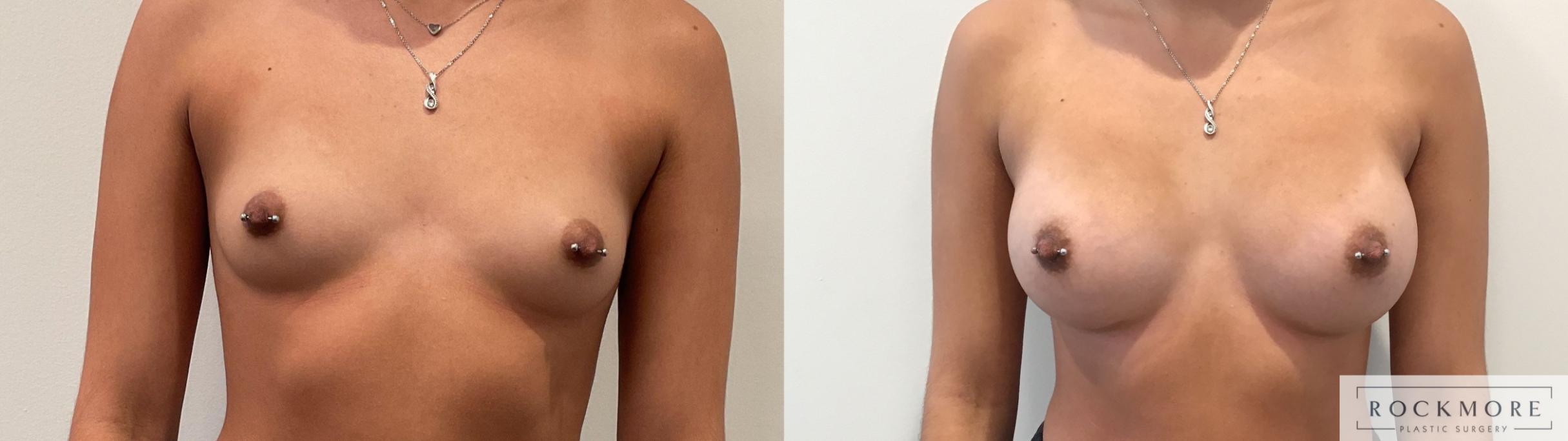 Before & After Breast Augmentation Case 458 Front View in Albany & Latham, New York