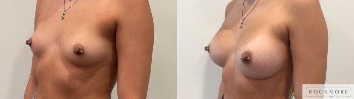 Before & After Breast Augmentation Case 458 Left Oblique View in Albany & Latham, New York