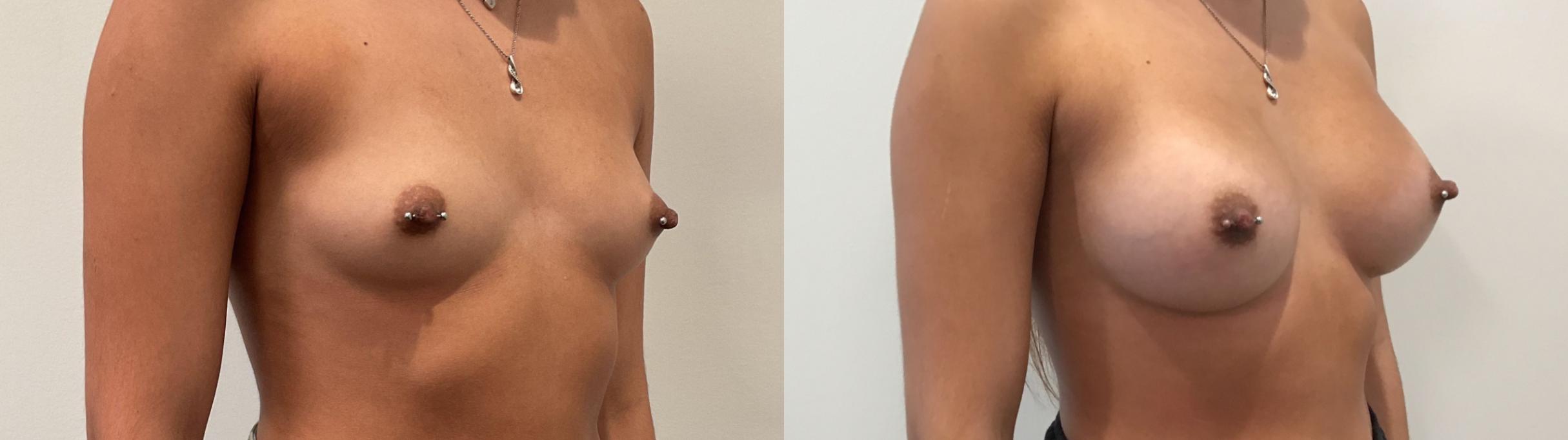 Before & After Breast Augmentation Case 458 Right Oblique View in Albany, Latham & Saratoga, New York