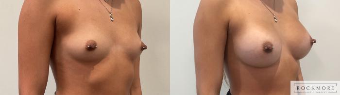 Before & After Breast Augmentation Case 458 Right Oblique View in Albany & Latham, New York