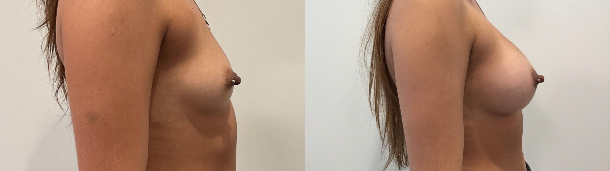 Before & After Breast Augmentation Case 458 Right Side View in Albany, Latham & Saratoga, New York