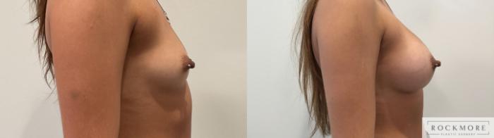 Before & After Breast Augmentation Case 458 Right Side View in Albany & Latham, New York