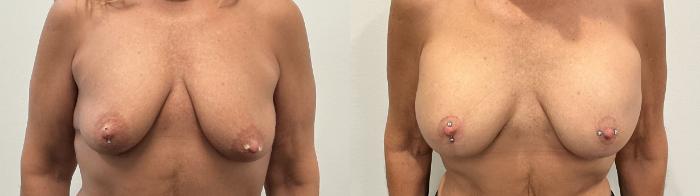 Before & After Breast Augmentation Case 483 Front View in Albany, Latham & Saratoga, New York