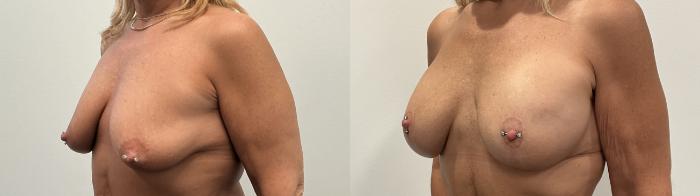 Before & After Breast Augmentation Case 483 Left Oblique View in Albany, Latham & Saratoga, New York