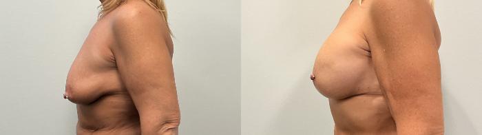 Before & After Breast Augmentation Case 483 Left Side View in Albany, Latham & Saratoga, New York