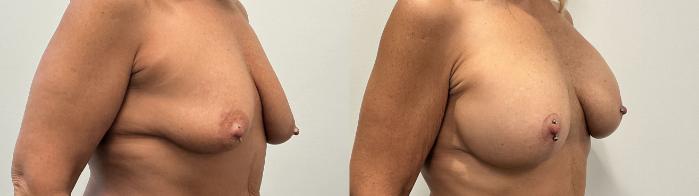 Before & After Breast Augmentation Case 483 Right Oblique View in Albany, Latham & Saratoga, New York