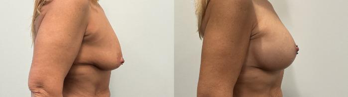 Before & After Breast Augmentation Case 483 Right Side View in Albany, Latham & Saratoga, New York
