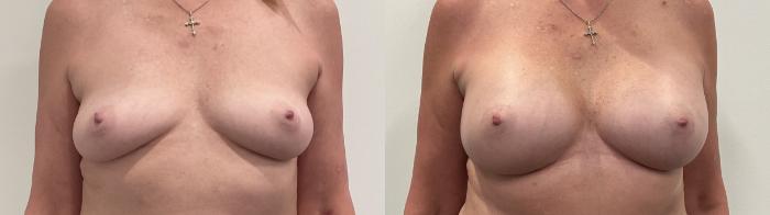 Before & After Breast Augmentation Case 489 Front View in Albany, Latham & Saratoga, New York