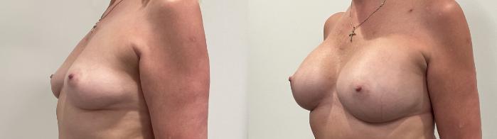 Before & After Breast Augmentation Case 489 Left Oblique View in Albany, Latham & Saratoga, New York