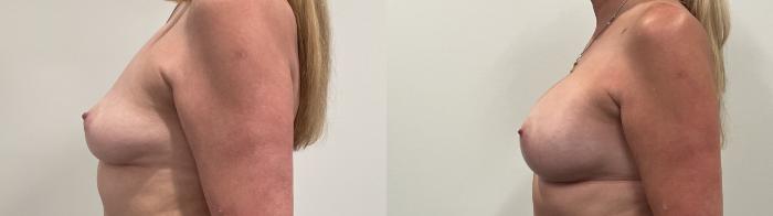 Before & After Breast Augmentation Case 489 Left Side View in Albany, Latham & Saratoga, New York