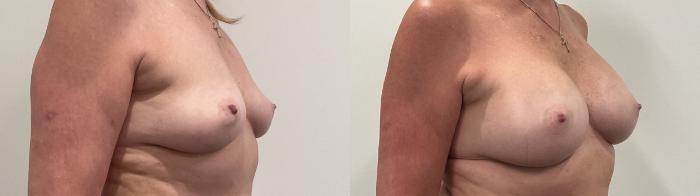 Before & After Breast Augmentation Case 489 Right Oblique View in Albany, Latham & Saratoga, New York