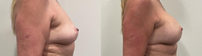 Before & After Breast Augmentation Case 489 Right Side View in Albany, Latham & Saratoga, New York