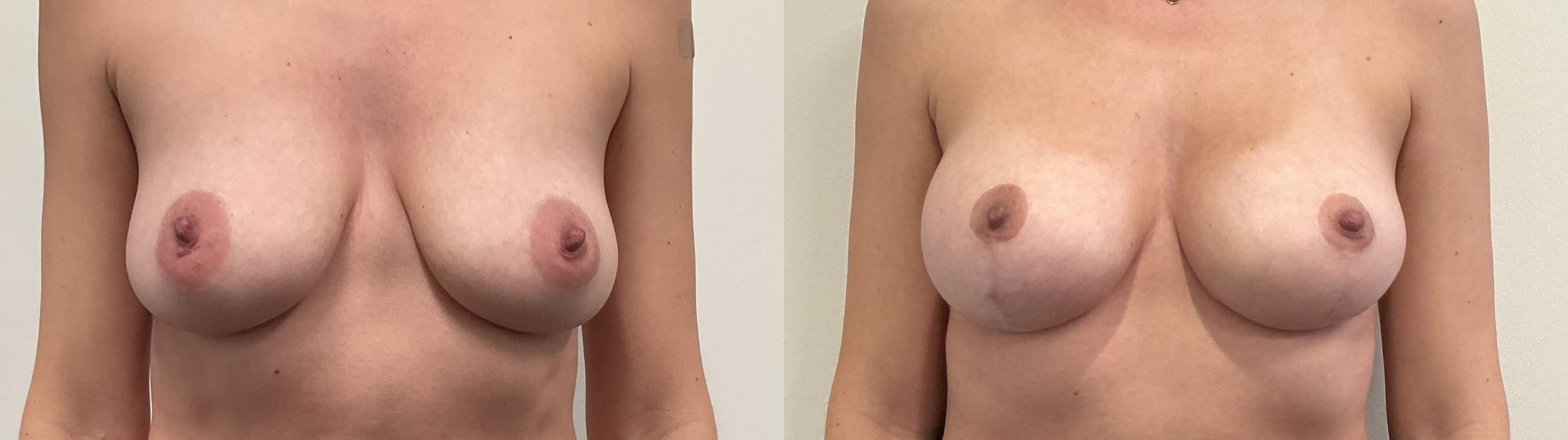 Before & After Breast Augmentation Case 491 Front View in Albany, Latham & Saratoga, New York