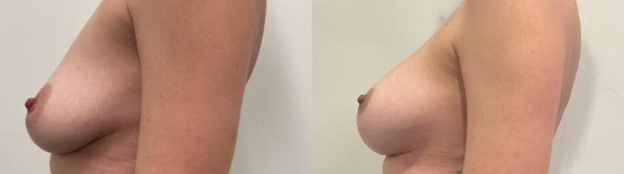 Before & After Breast Augmentation Case 491 Left Side View in Albany, Latham & Saratoga, New York