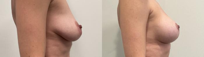 Before & After Breast Augmentation Case 491 Right Side View in Albany, Latham & Saratoga, New York