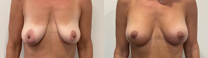 Before & After Breast Augmentation Case 492 Front View in Albany, Latham & Saratoga, New York