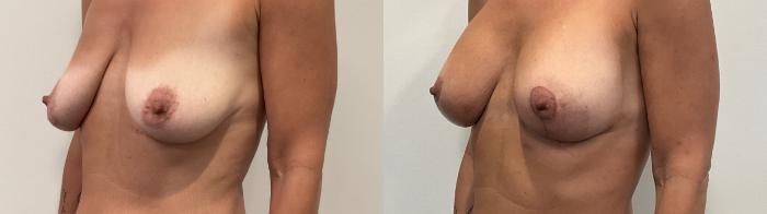 Before & After Breast Augmentation Case 492 Left Oblique View in Albany, Latham & Saratoga, New York