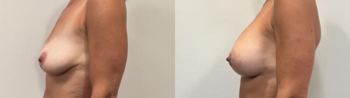 Before & After Breast Augmentation Case 492 Left Side View in Albany, Latham & Saratoga, New York