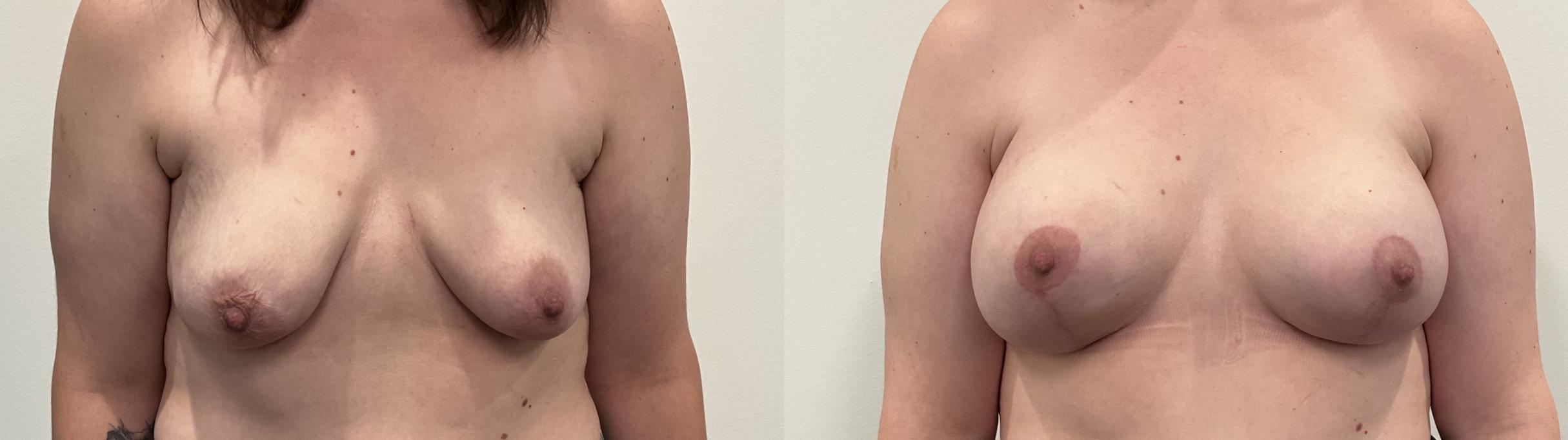 Before & After Breast Augmentation Case 498 Front View in Albany, Latham & Saratoga, New York