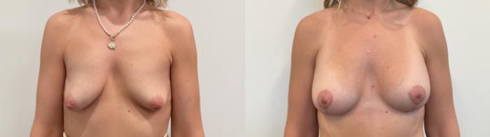 Before & After Breast Lift Case 500 Front View in Albany, Latham & Saratoga, New York